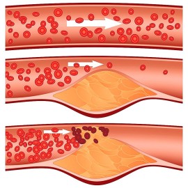 What You Can Do About Your Cholesterol