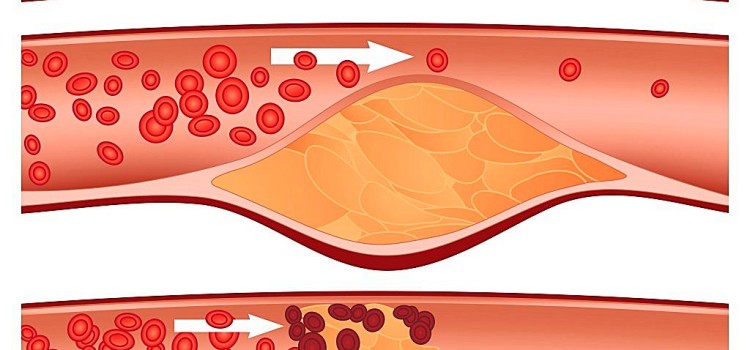 What You Can Do About Your Cholesterol